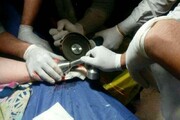 دست کودک ۱۸ ماهه قزوینی از چرخ گوشت رهاسازی شد